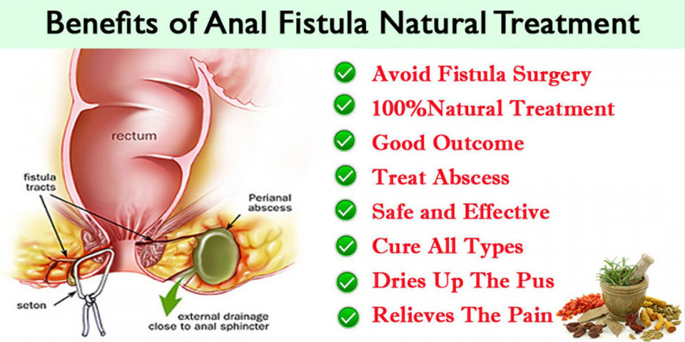 Anal Fistula Natural Treatment