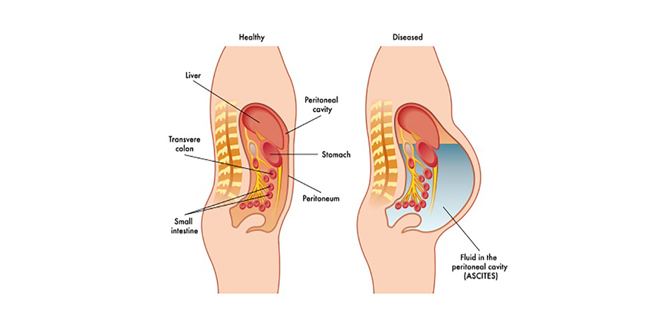 Fluid in the peritoneol
