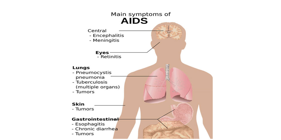 AIDS