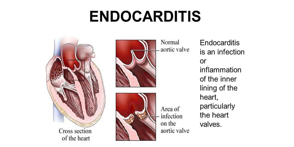 Endocarditis