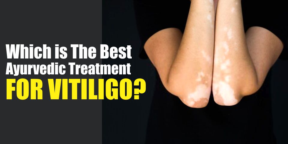 Ayurvedic Treatment For Vitiligo Leucoderma