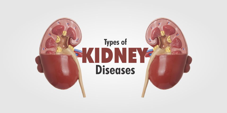 Symptoms of Kidney Stones