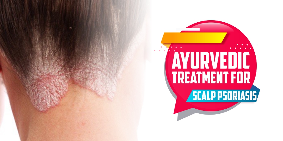 Ayurvedic Treatment for Scalp Psoriasis