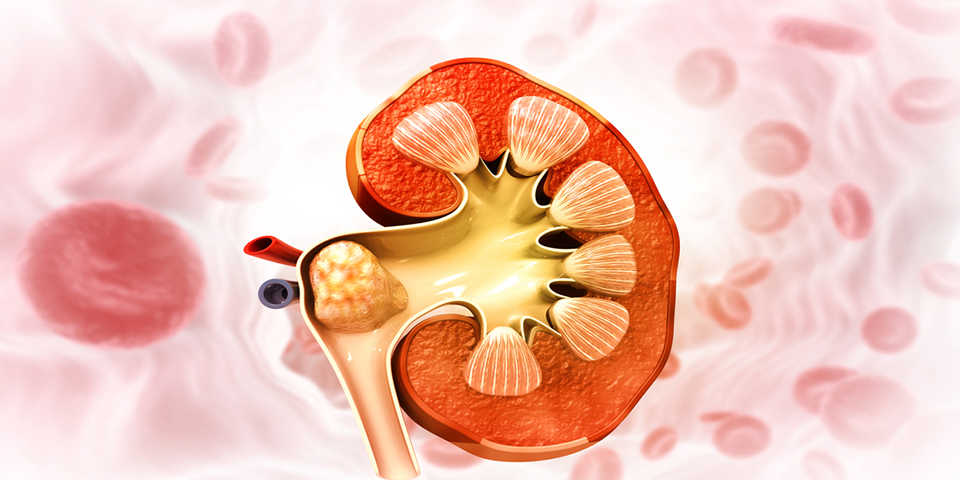 Kidney Stone