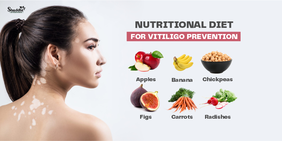 Ayurvedic remedies for vitiligo