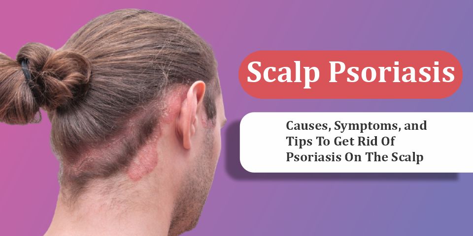Scalp Psoriasis