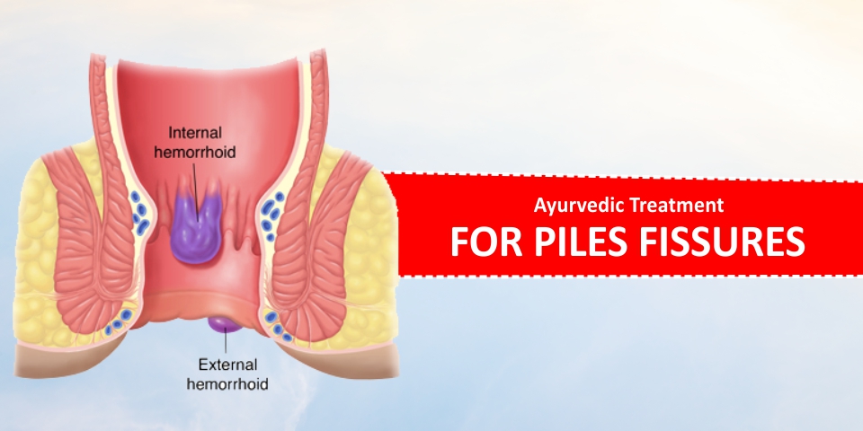 Ayurvedic Treatment For Piles And Fissures