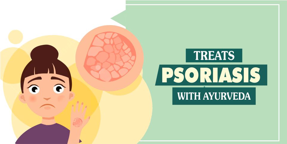 Best Ayurvedic Treatment For Psoriasis