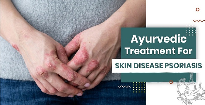 ayurvedic treatment for skin disease psoriasis