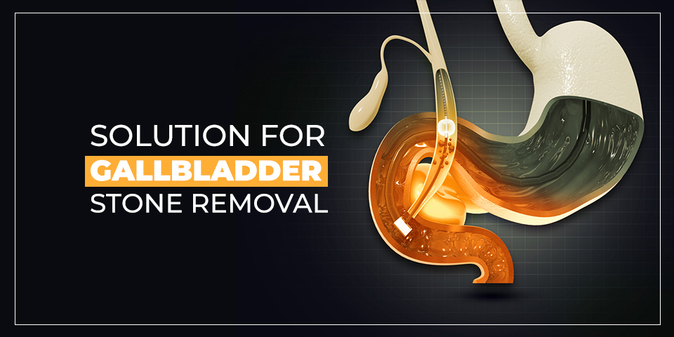 solution for gallbladder stone removal