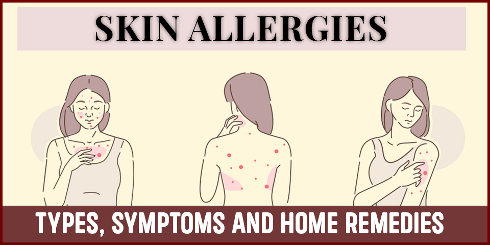 Skin Allergies Types, Symptoms and Home Remedies