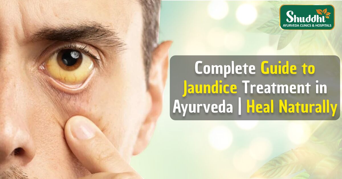 Jaundice Treatment in Ayurveda