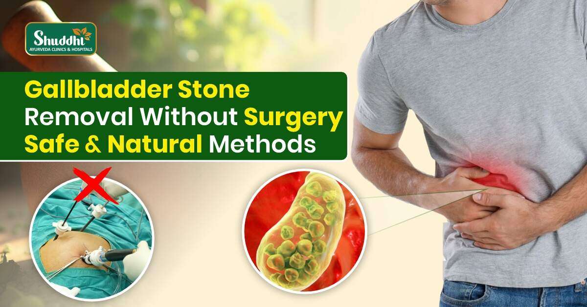 Gallbladder Stone Removal Without Surgery